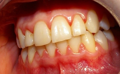Gydymas nuo gingivito: burnos higiena